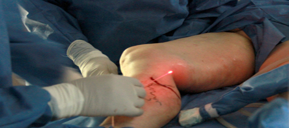 laser_endovascular.html